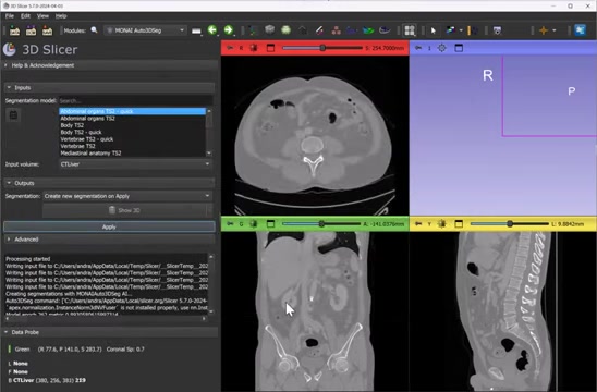 3D Slicer & MONAI: Fast Medical Image Segmentation Guide