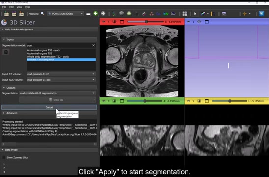 3D Slicer & MONAI: Fast Medical Image Segmentation Guide